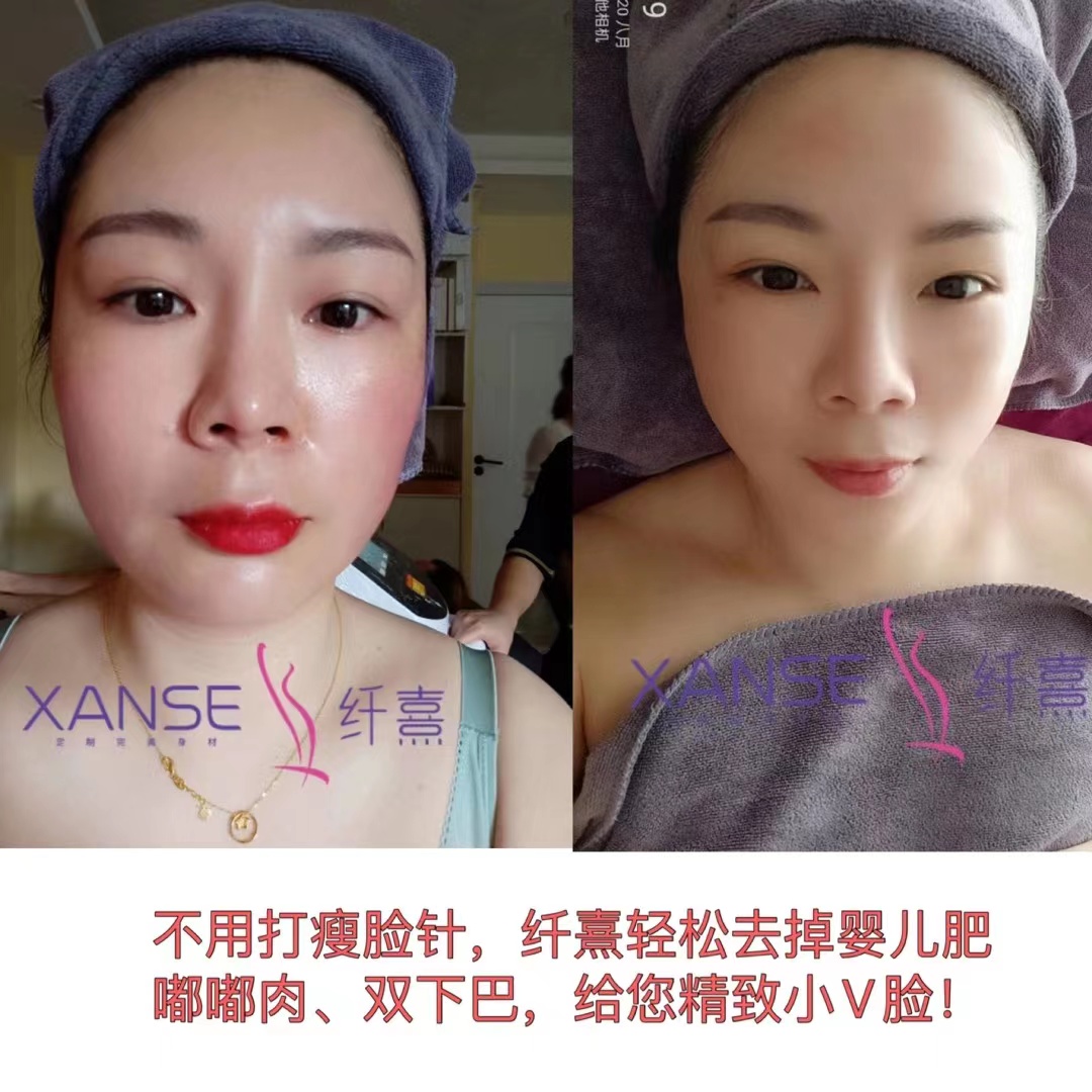 纤熹效果展示---面部