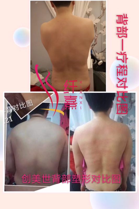 背部一疗程对比图